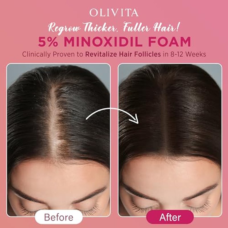 5% Minoxidil Foam for Women & Men Hair Regrowth - 2pcs