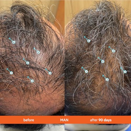 Revita Hair Density Shampoo for Thinning Hair - 205 mL (2 Pack)