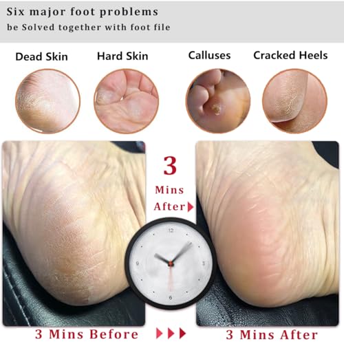 Kinepi Double-Sided Foot File & Pumice Stone Callus Remover with Wood Handle
