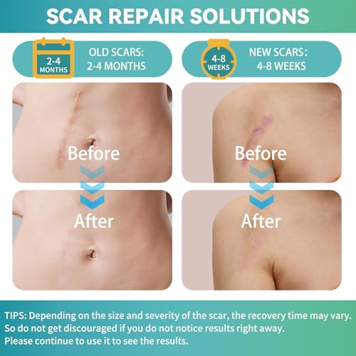 Silicone Scar Tape, Silicone Scar Sheets(1.6"X 160" Roll-4M), Reusable Medical Grade Silicone Tape for Scars, C-Section, Keloid, Acne, Tummy Tuck, Surgical Scars, Light