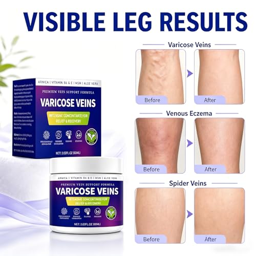Varicose Veins Cream for Legs with MSM & Arnica