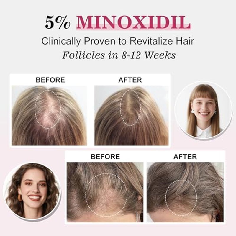 5% Minoxidil Hair Regrowth Spray for Women with Biotin