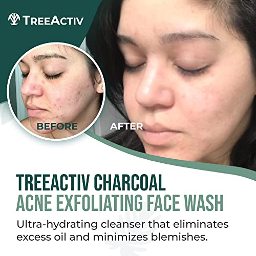 TreeActiv Acne Charcoal Face Wash 3.4 oz, Exfoliating Daily Honey & Sulfur Acne Cleanser Face Soap, Deep Cleansing Moisturizing Face Wash for Women and Men