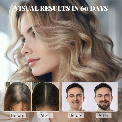 5% Minoxidil Spray for Hair Growth – Biotin Serum for Men & Women