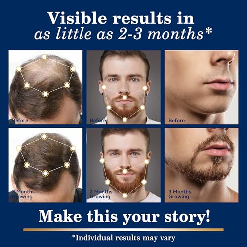 5% Minoxidil Hair Regrowth Spray for Men & Women