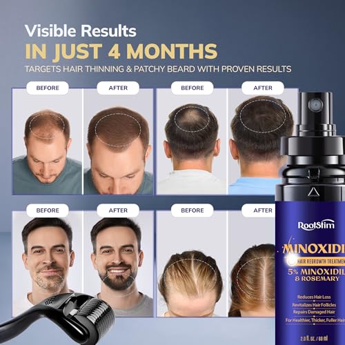 5% Minoxidil Spray + 0.25mm Derma Roller Hair Regrowth Kit