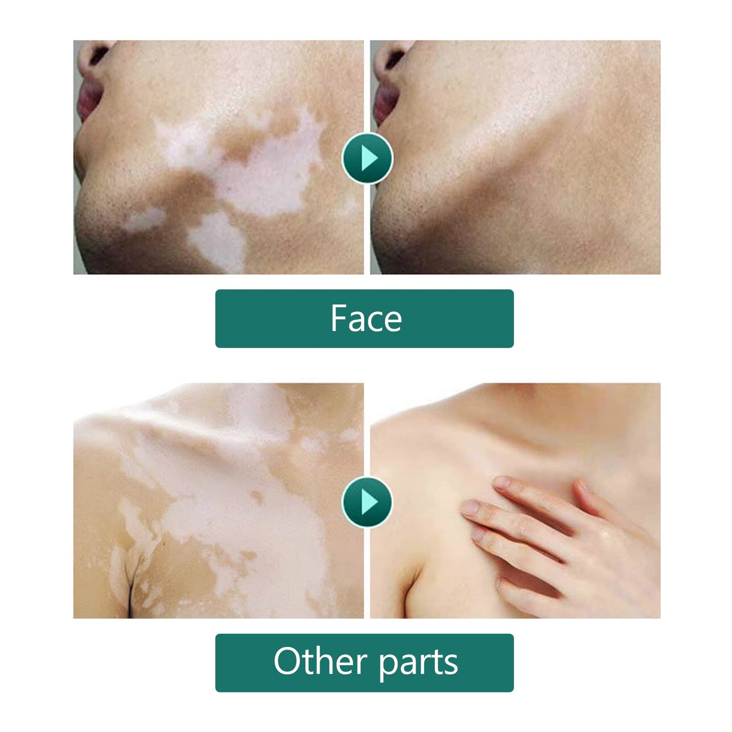 20ml Vitiligo Covering Liquid, White spot concealer, Waterproof Makeup Vitiligo Concealer Cosmetics for Face Body, skin tone concealer