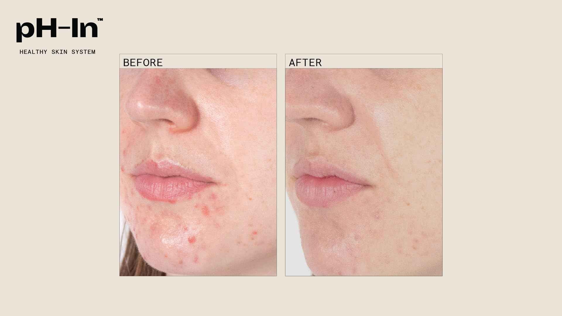 pH-In 3 Step Healthy Skin System
