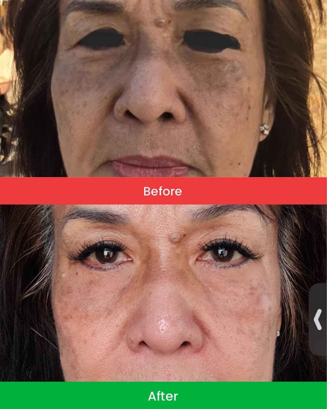 CHANVIDA Whitening Facial Cream 3-OETHYL Ascorbic Acid, Niacinamide, Hydoxypinacolone Retinoate, Ceramides, Plus Natural Ingredients Reduce Hyperpimentation, Dark Spots, Enlarged Pores & Fine Lines.