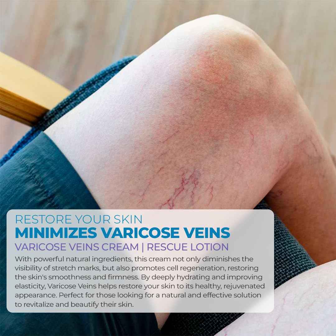 CLG Skincare Varicose Veins Cream - Skin Rescue Lotion for Smoother, Healthier Legs - Advanced Formula for Varicose Veins Improvement, Circulation & Skin Firming, Plant-Based Ingredients, 8 oz (1)