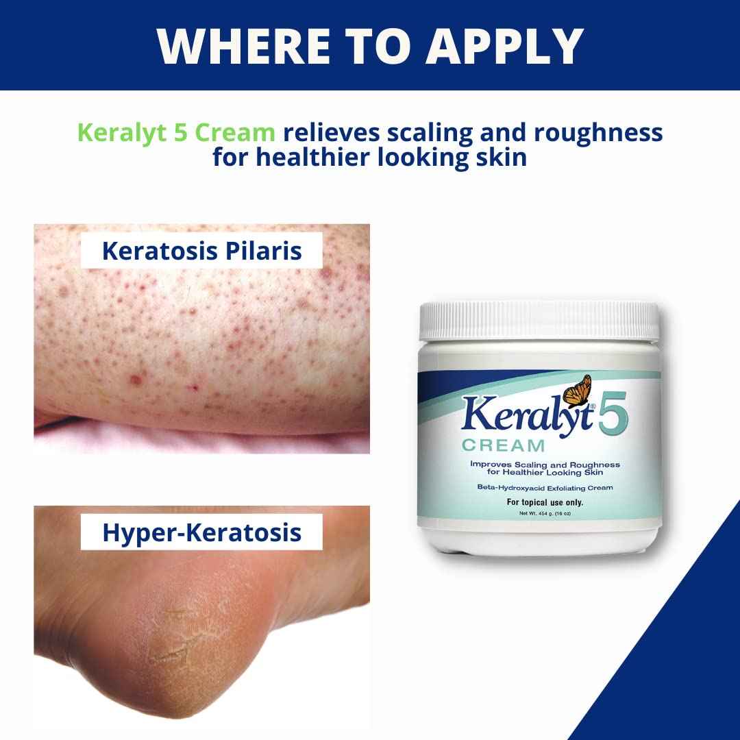 Keralyt 5 Psoriasis Cream - Full Body 5% Salicylic Acid Exfoliating Skin Lotion - Promotes Relief from Itchy, Redness, Dryness, Roughness, and Flakey Skin