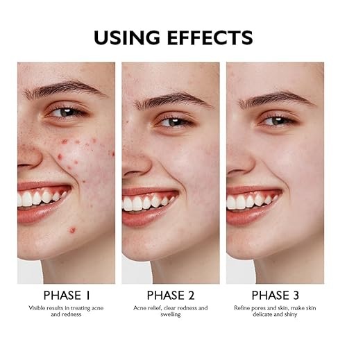 Azelaic Acid Serum for Face Acne Treatment, Body Acne Clearing Treatment with 10% Azelaic Acid & Salicylic Acid, Sensitive Skin Care Facial Essential Cream for Recurring Breakouts Refine Pores 30ml