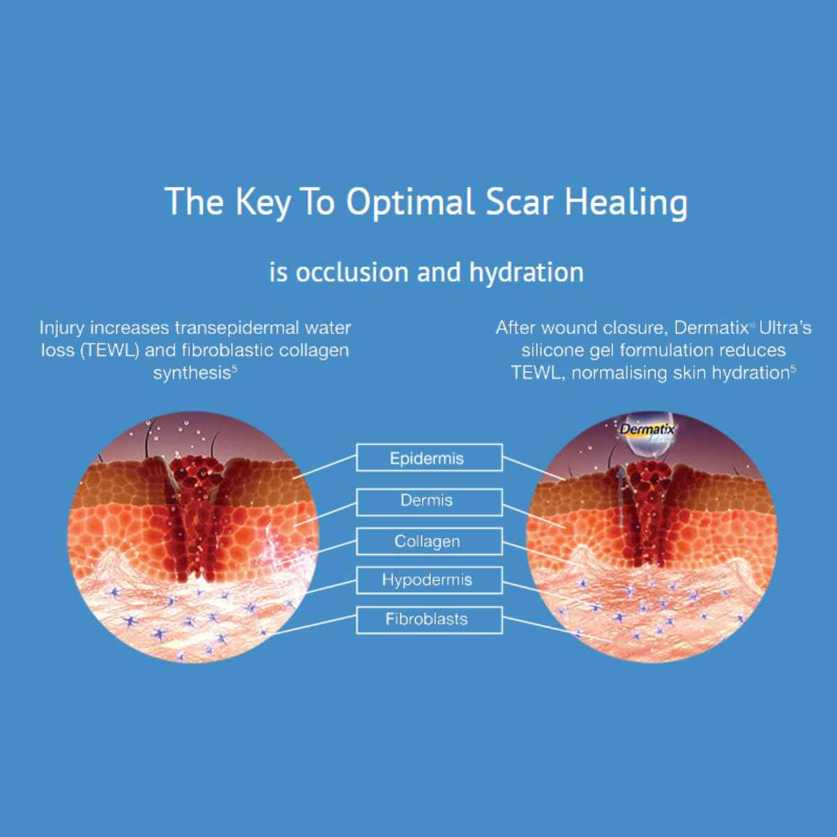 Dermatix Ultra Advanced Scar Gel - 15g, Softens and Flattens Scars, Quick-Drying and Odorless Formula