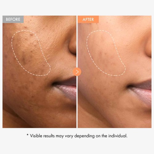 NATUREKIND Niacinamide Vitamin Ampoule - 20,000ppm Vitamin B3 Concentrated Serum, Panthenol, Hydrating, Fine Lines, Post Acne Marks, Uneven Skin Tone & Dull Skin, Korean Skin Care, 100ml, 3.38 fl.oz.