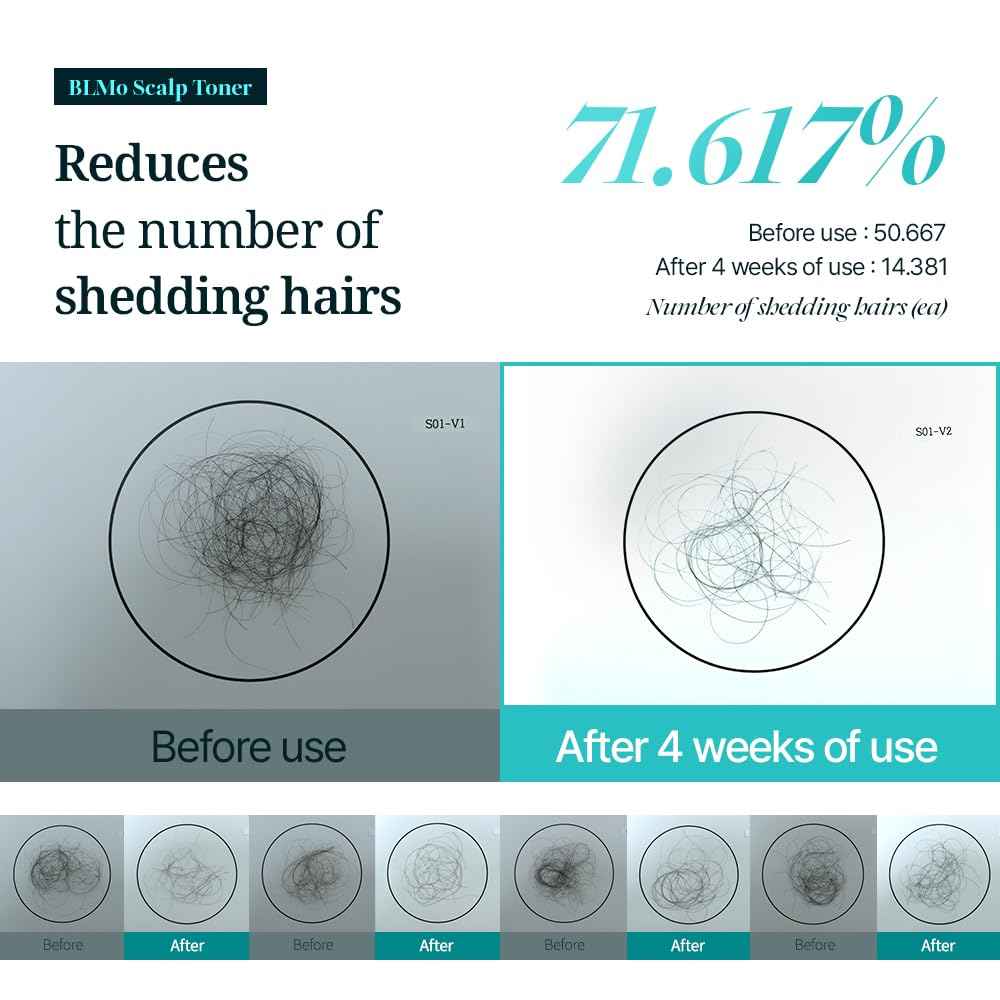 Scalp Serum for Hair Loss & Thinning with Massaging Tips | Clinically Proven | Thickens & Accelerates Hair Growth | Supports DHT Balance | Korean Hair Care | Low Irritation, Drug-Free | 4.05 fl.oz