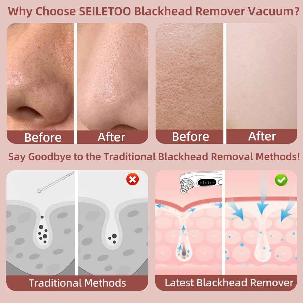 5-Speed Blackhead Remover Vacuum, Wireless Charging Nose Pore Extractor with 4 Removable Heads,Facial Vacuum Pore Cleaner,30-Second Keratin Softening, Hypoallergenic Deep Cleansing