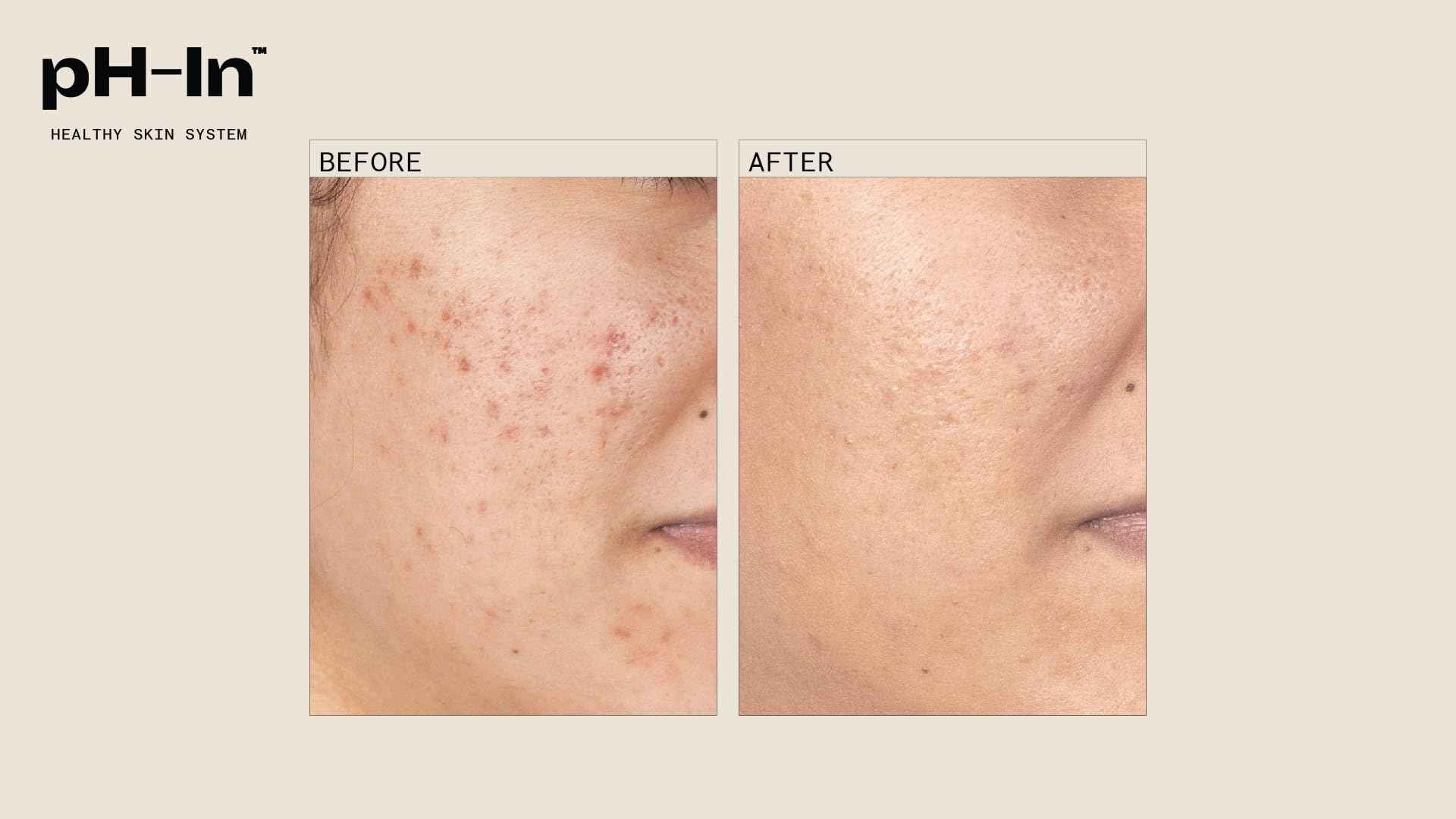 pH-In 3 Step Healthy Skin System