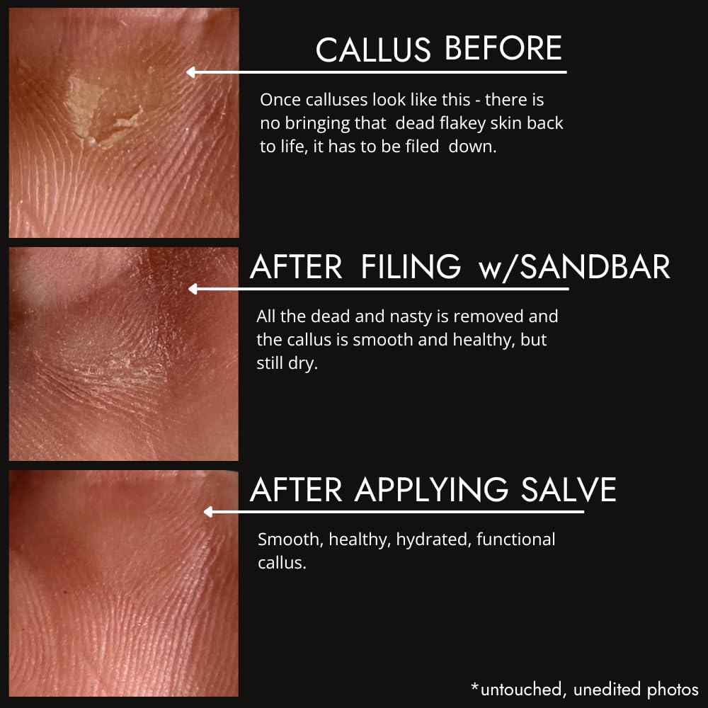 SandBar Natural Callus Salve - Revitalizing Callus Balm - Heal, Nourish & Maintain Your Calluses - On The Go Callus Repair & Care - Convenient Essential - Immediate Relief For Callus Tears