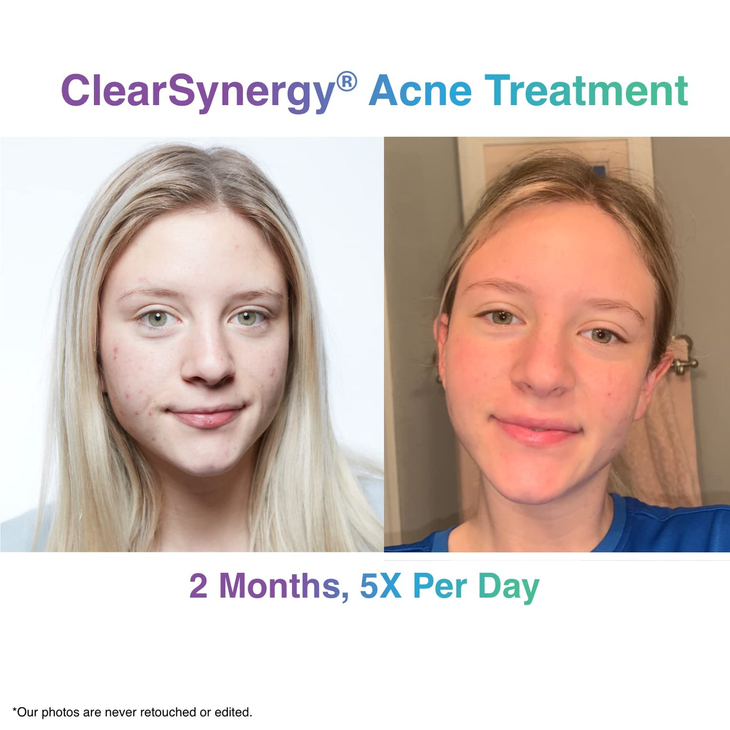 ClearSynergy One-Step Acne Treatment Foam, Dermatologist Tested, Non-Irritating, Safe for All Skin Types Including Sensitive Skin, Vanishes Quickly, Fragrance Free, 1.69 Fl Oz