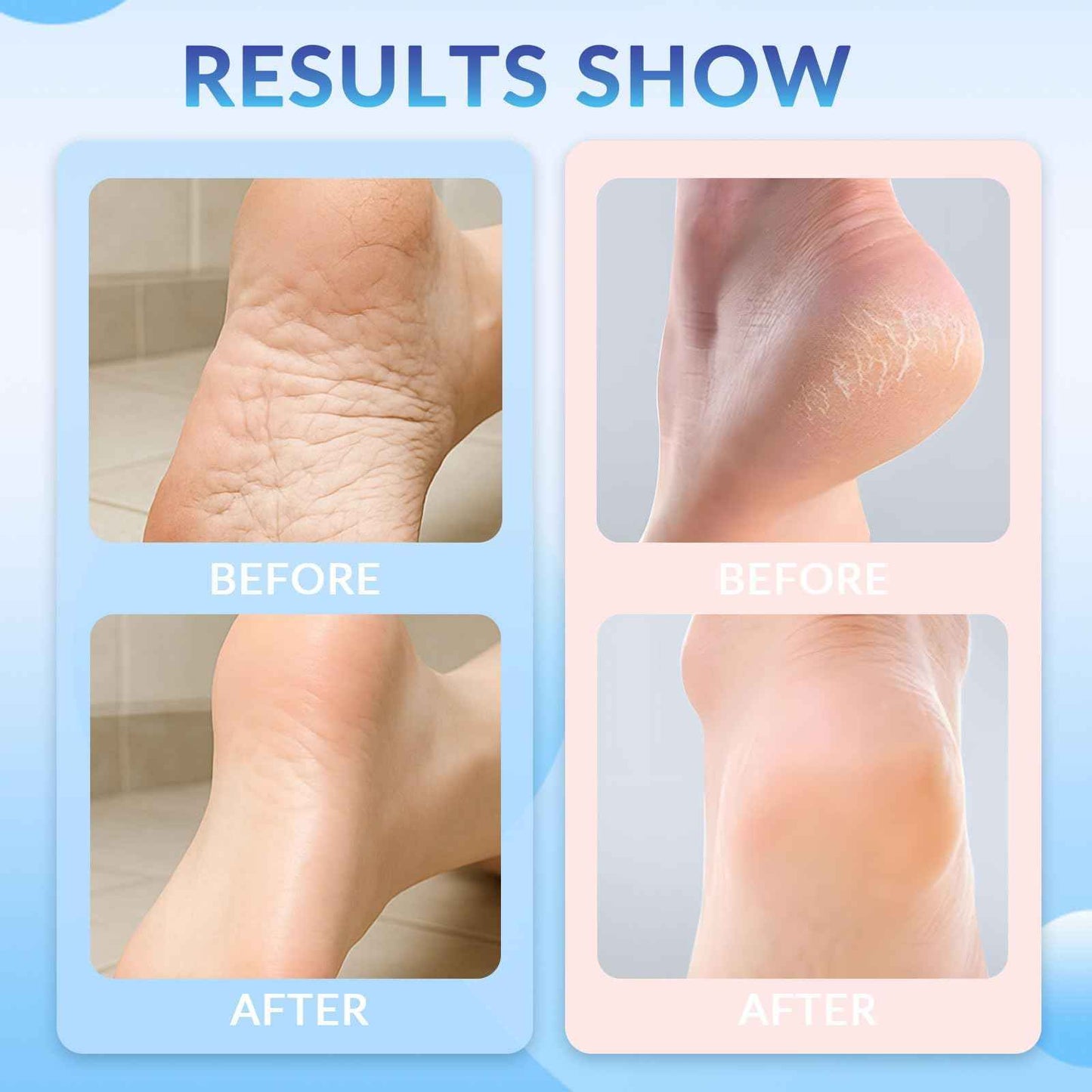 Awjsde Crack Feet Prevention Stick, Foot Care Cream, Anti Cracked Foot Balm, Softening and Nourishing Creams for Dry, Remove Dead Skin and Moisturize Dry Skin (BLUE+PINK)