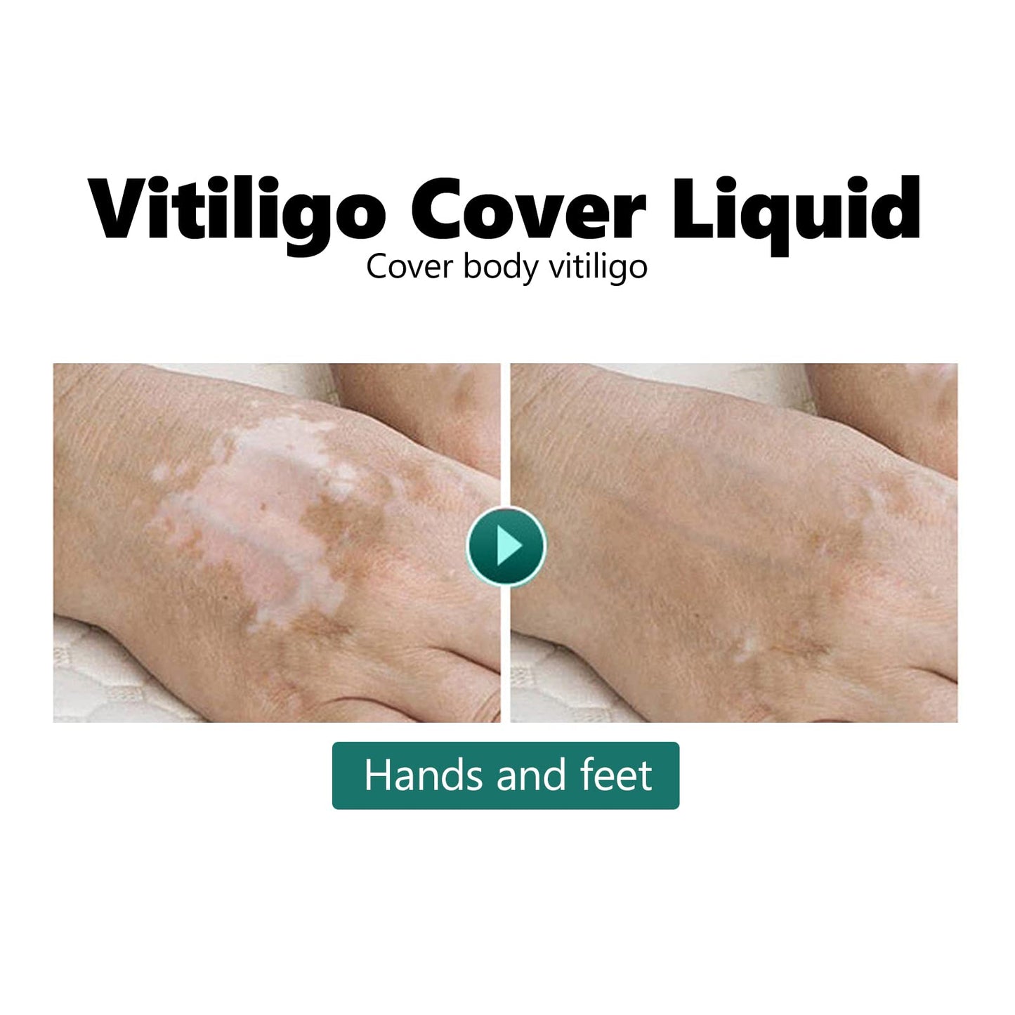 20ml Vitiligo Covering Liquid, White spot concealer, Waterproof Makeup Vitiligo Concealer Cosmetics for Face Body, skin tone concealer