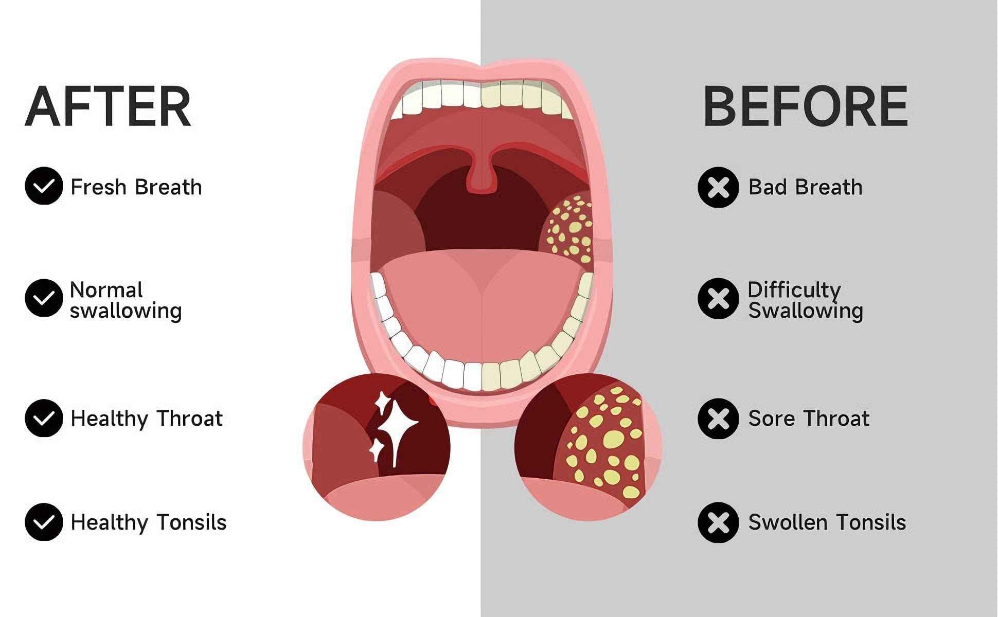 Electric Tonsil Stone Remover Kit - 5 Silicone Tips, 3 Suction Levels, Rapid USB-C Charging, Integrated LED - Gentle & Painless for Home Use, Doctor Recommended