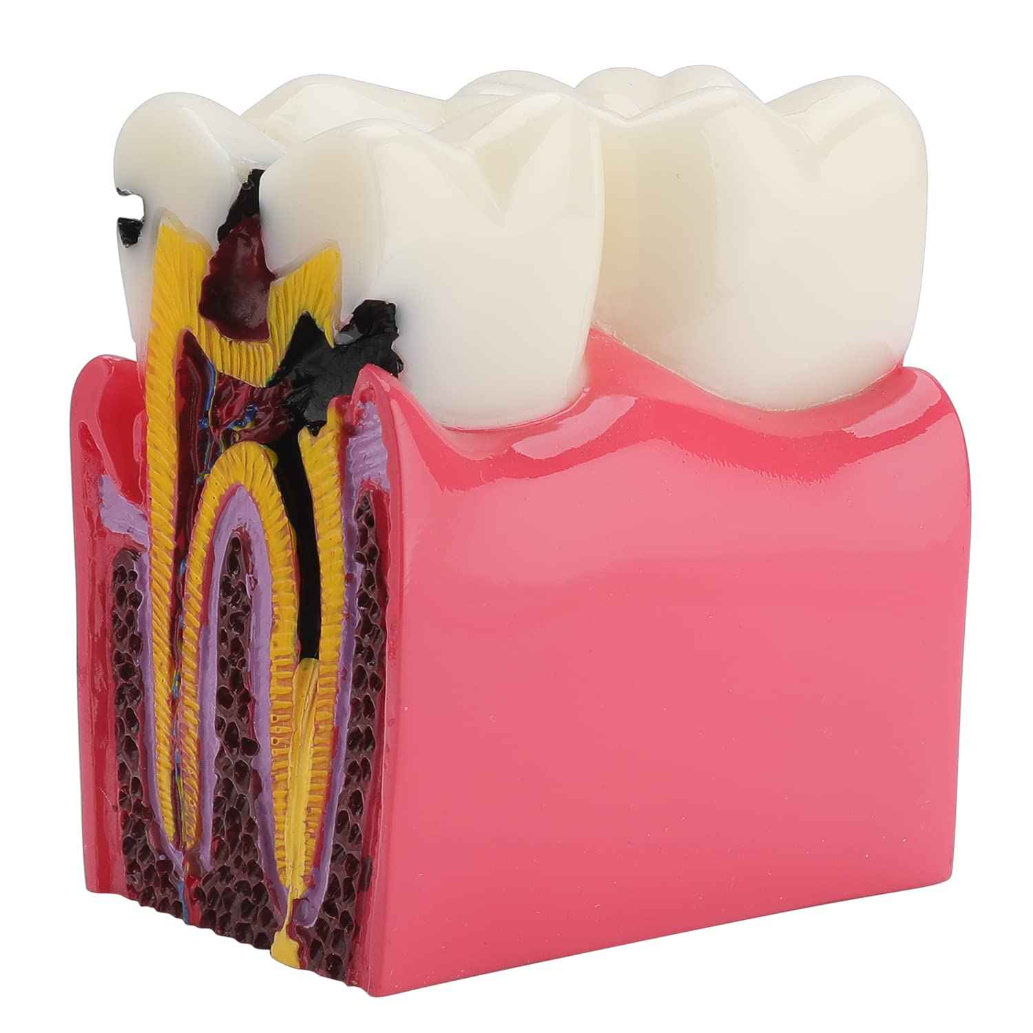 faruijie Dental Caries Tooth Model - 6 Times Caries Anatomy Dental Care Teeth Model Decay Teeth Comparative Education Model Dental Model Teaching for Patient Education