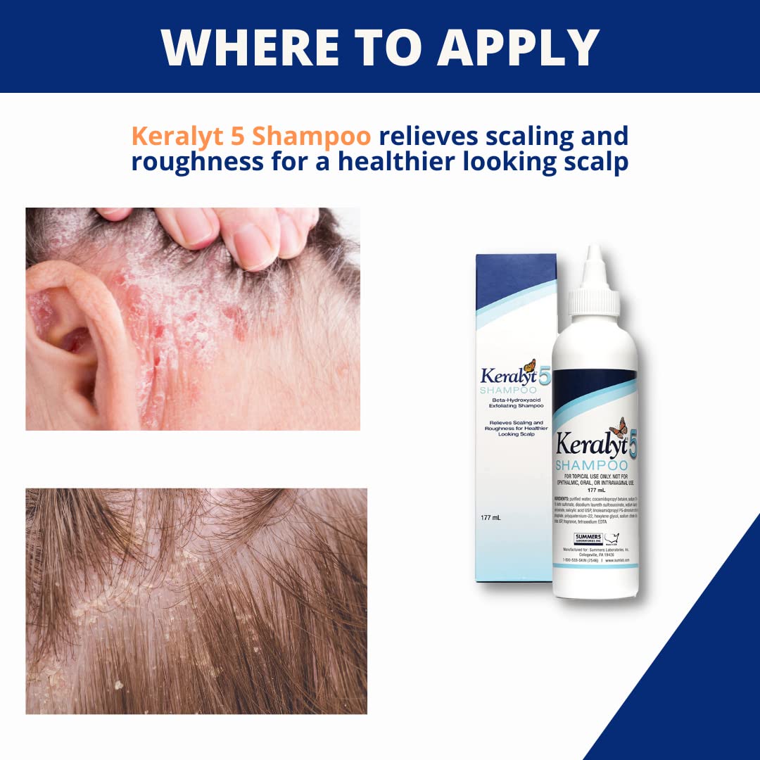 Keralyt 5 Anti-Dandruff Shampoo - Max Strength 5% Salicylic Acid Scalp Build-Up Clearing - Promotes Relief from Dandruff, Psoriasis, Seborrheic Dermatitis, Dryness, and Itchiness, 177 milliliters