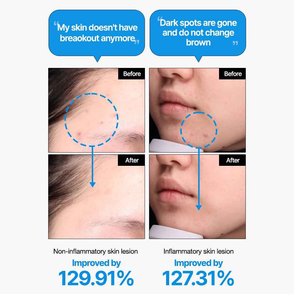 Feld Apotheke PHYTO CALM SERUM, PhytoCalm Anti-Blemish, 5-Herb Hydration & Soothing Serum, Soothes Skin Irritation, Supports Clear Skin, 1.01fl.oz/30ml