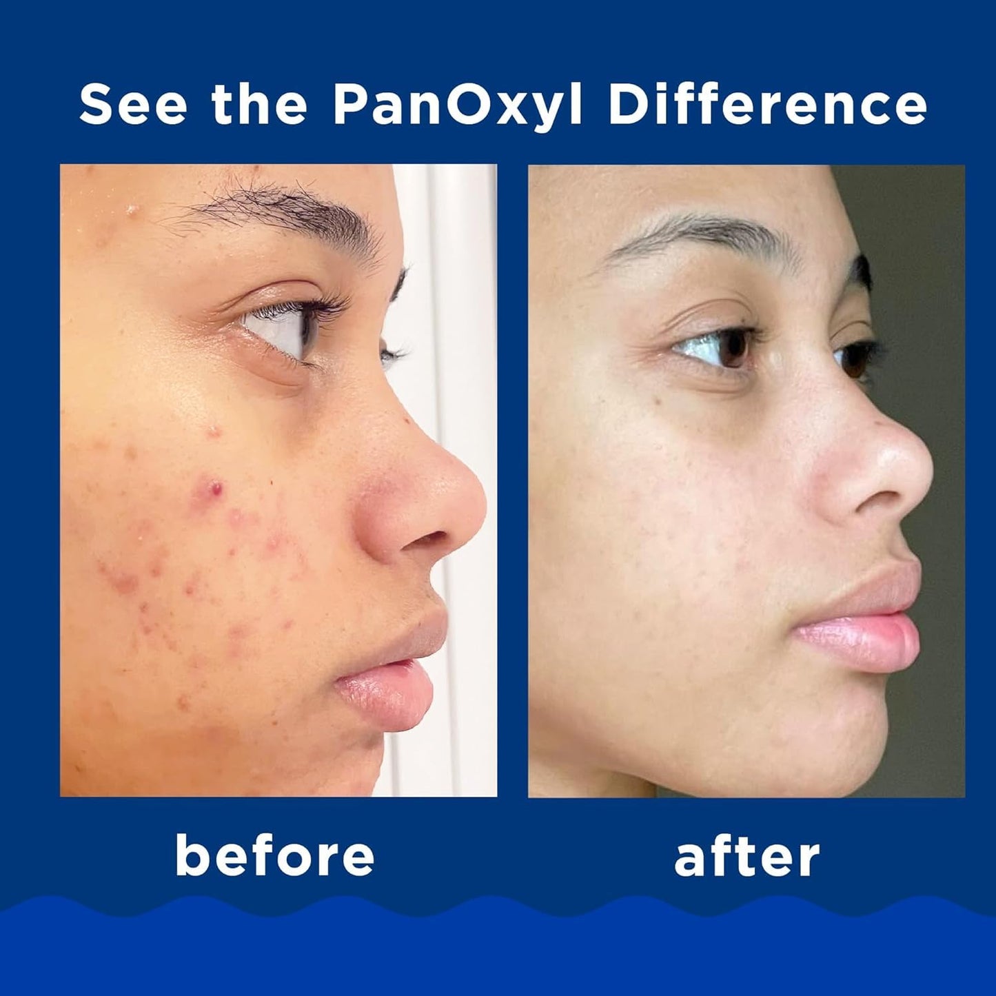 PanOxyl 10% Acne Foaming Wash 5.5 Ounce (Value Pack of 2)