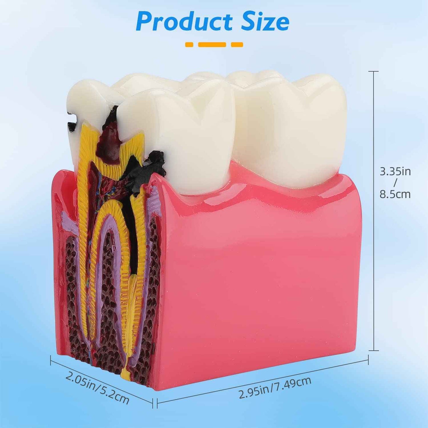 faruijie Dental Caries Tooth Model - 6 Times Caries Anatomy Dental Care Teeth Model Decay Teeth Comparative Education Model Dental Model Teaching for Patient Education
