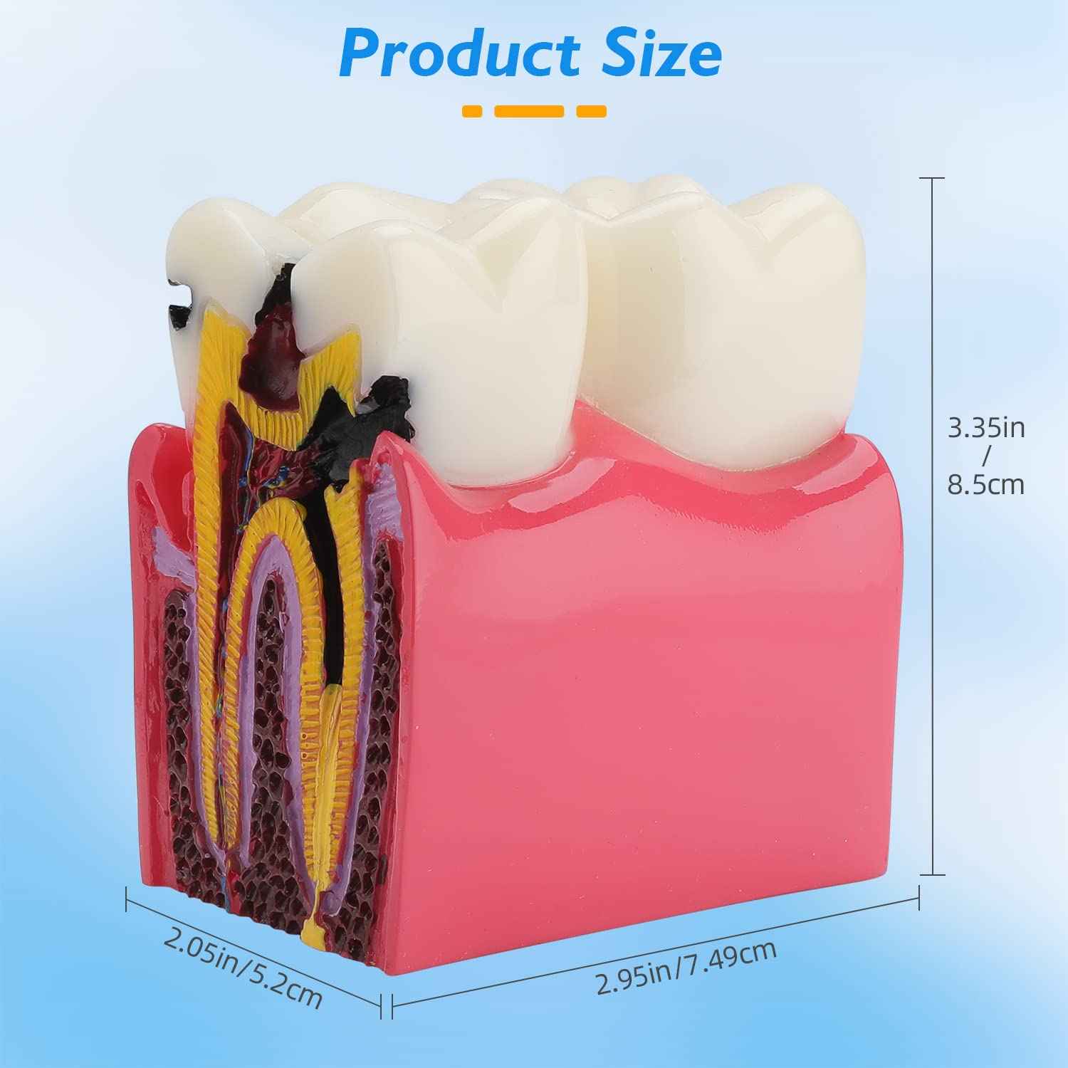 faruijie Dental Caries Tooth Model - 6 Times Caries Anatomy Dental Care Teeth Model Decay Teeth Comparative Education Model Dental Model Teaching for Patient Education