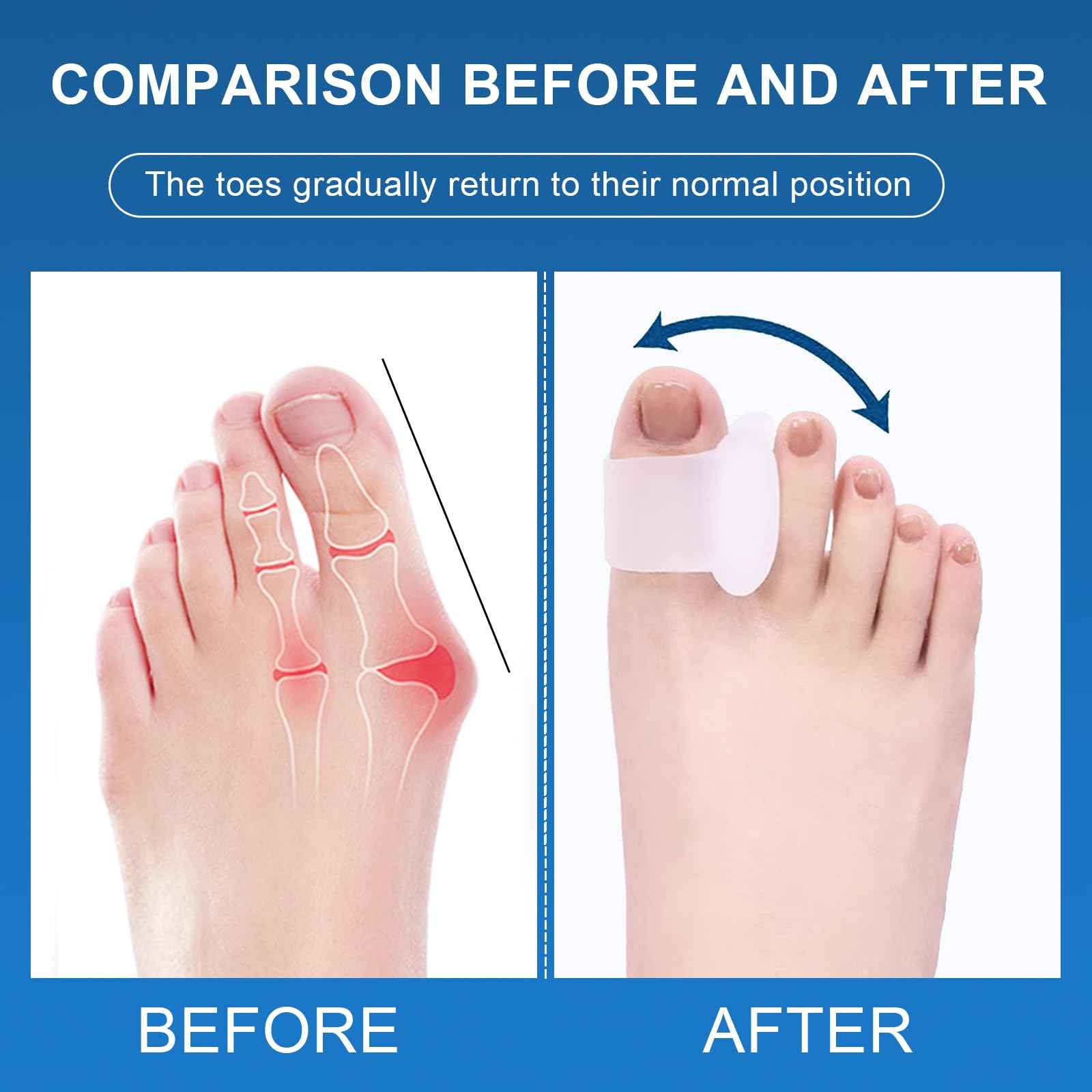Pack of 10 Toe Spacers for Overlapping Toes, Gel Toe Separators for Men and Women, Correcting Bunions, Bunion Relief, Big Toe Alignment, Hammer Toe Straightener, Corrector and Spacer(Transparent)