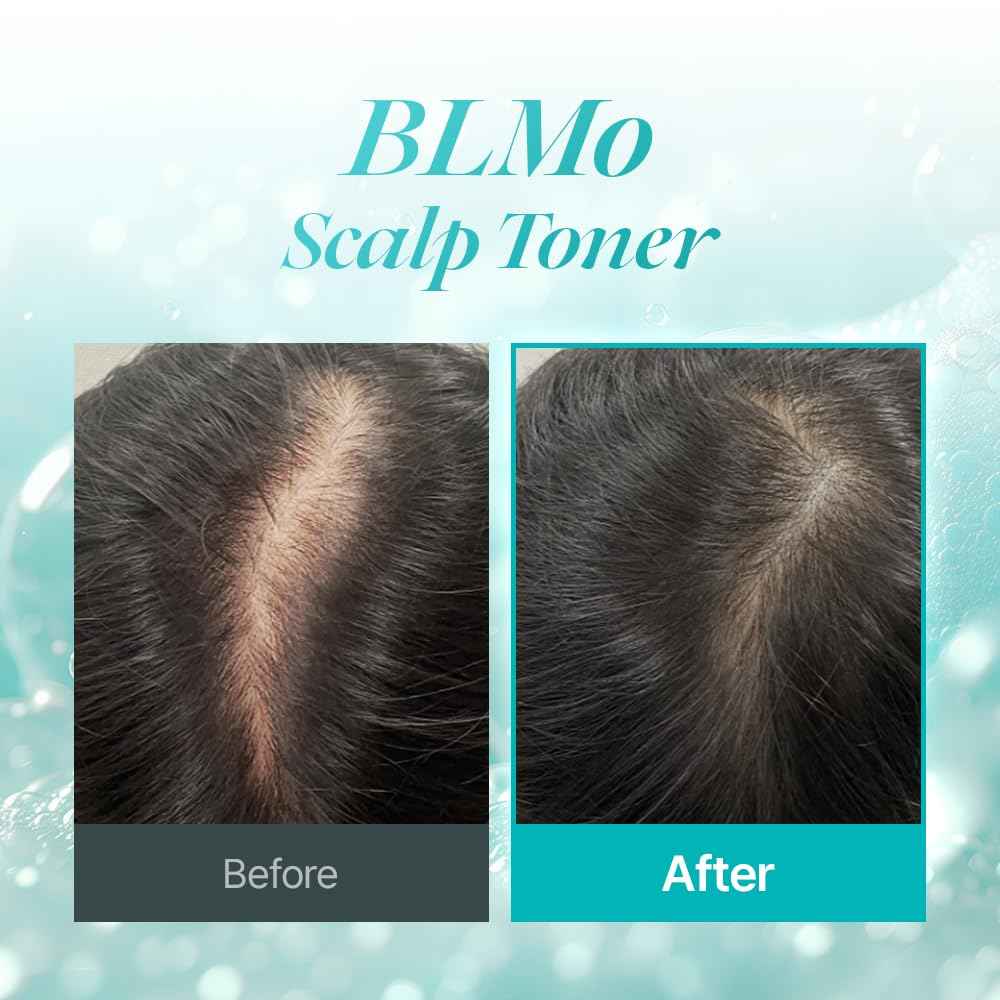 Scalp Serum for Hair Loss & Thinning with Massaging Tips | Clinically Proven | Thickens & Accelerates Hair Growth | Supports DHT Balance | Korean Hair Care | Low Irritation, Drug-Free | 4.05 fl.oz