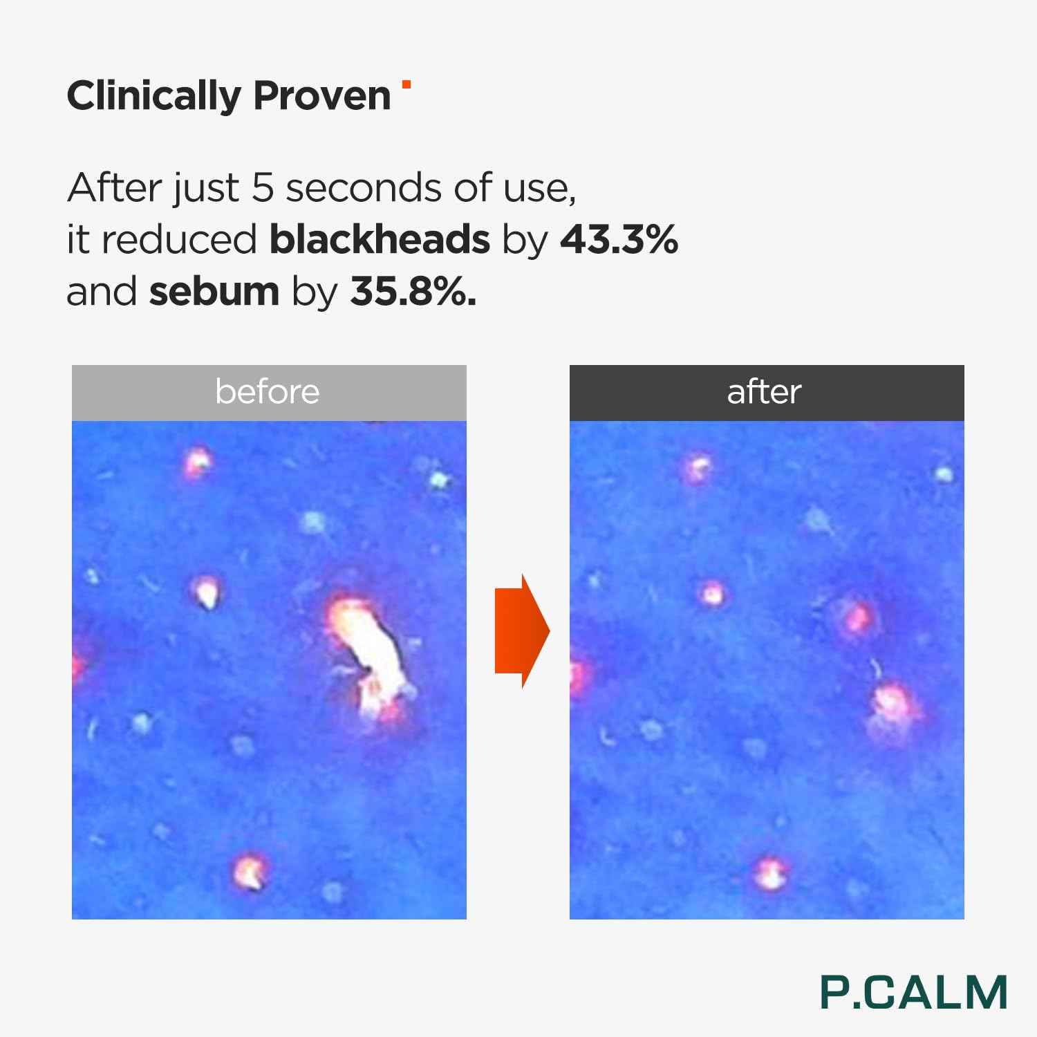 P.CALM Blackhead Removing & Pore Minimizing Duo | Holi Basil Cleansing Oil with Retinolagen Serum | Vegan Korean Skincare