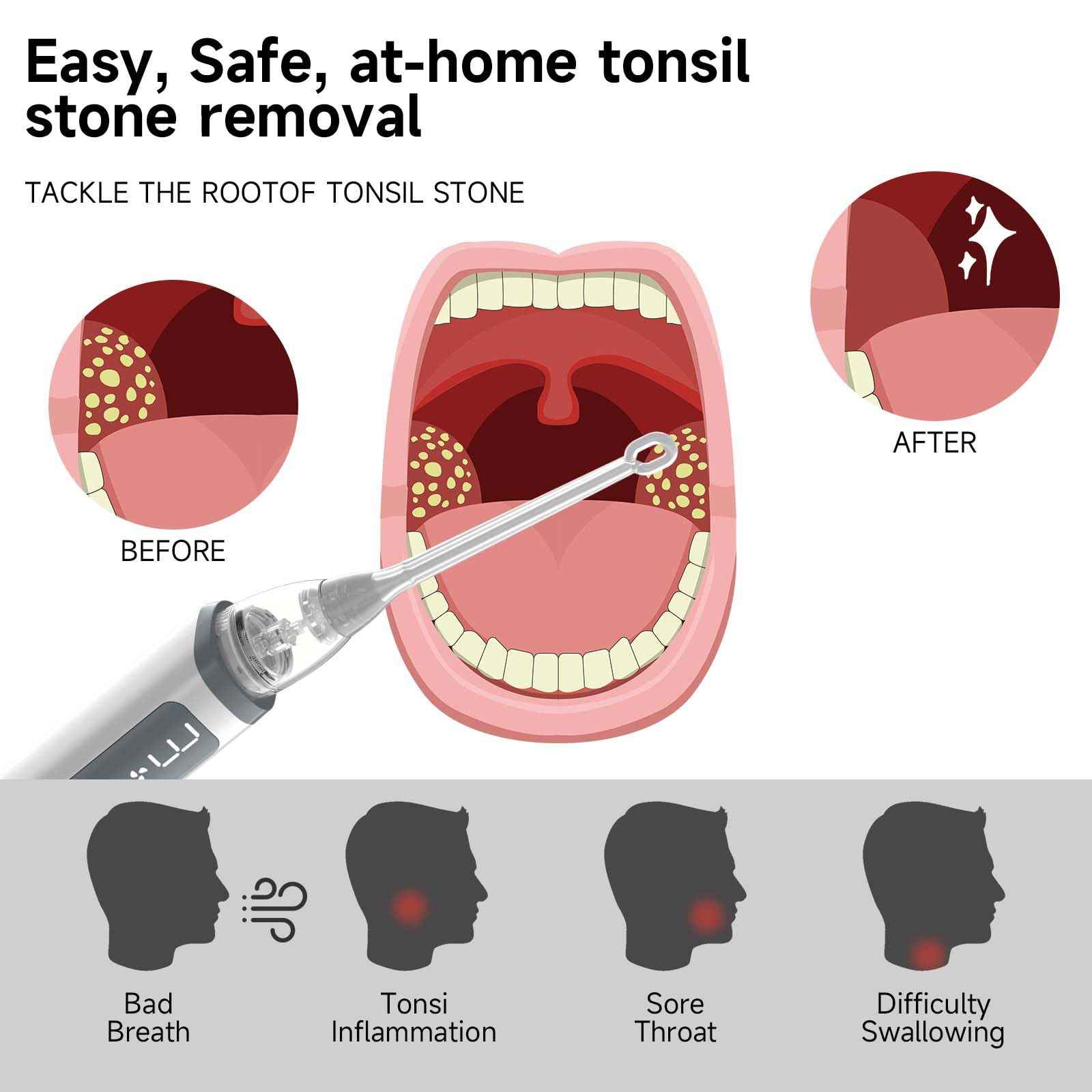 Electric Tonsil Stone Remover Kit - 5 Silicone Tips, 3 Suction Levels, Rapid USB-C Charging, Integrated LED - Gentle & Painless for Home Use, Doctor Recommended