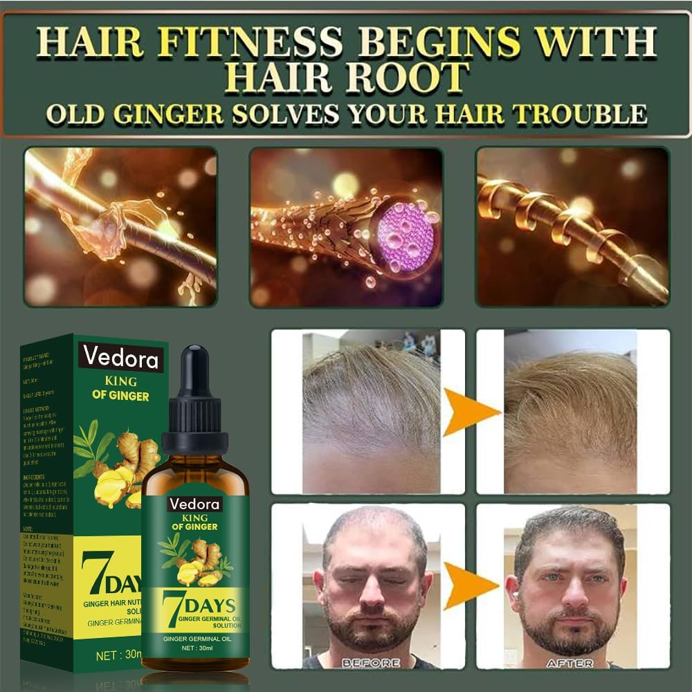 Vedora Ginger Oil for Hair Growth - Promotes Strong, Thick, Long Hair with Essential Ginger Serum - For Men & Women - 5.25 Fl Oz / 150ML (5pc)