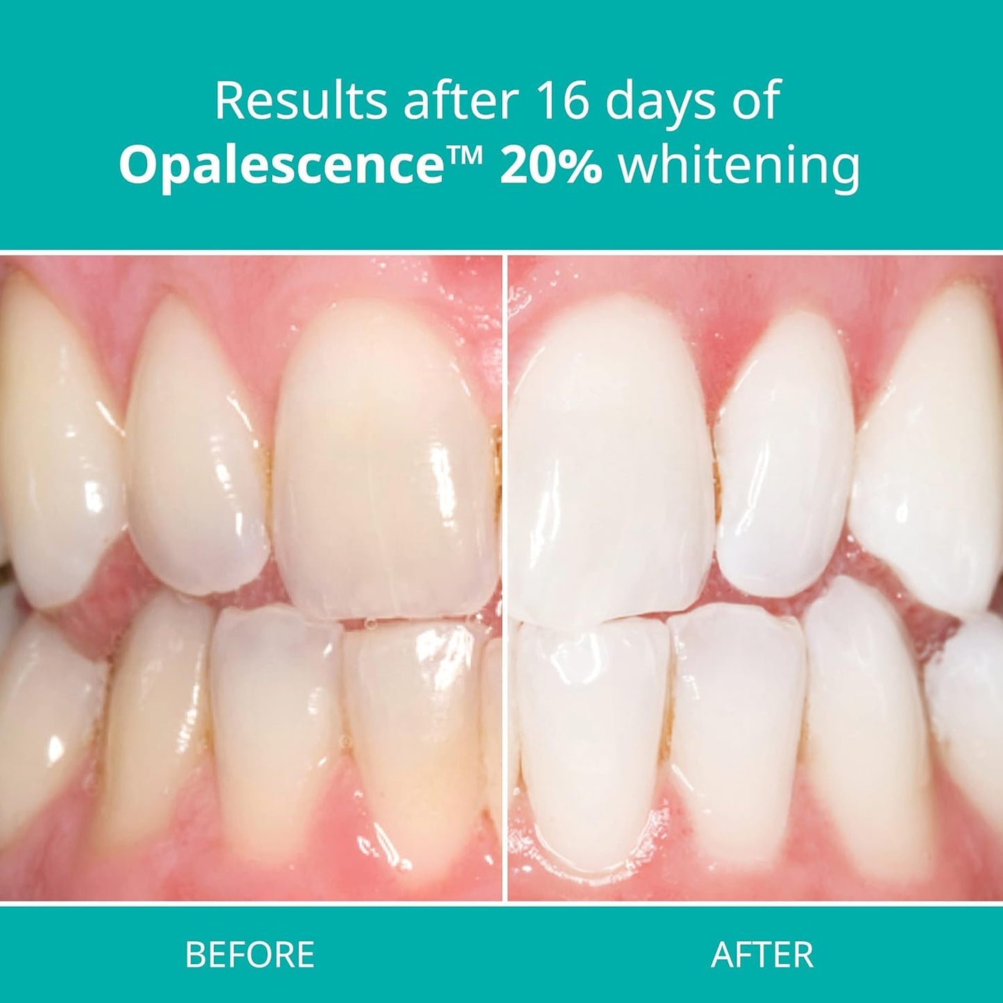 Opalescence 20% with PF Gel Syringes Teeth Whitening (2 Packs / 4 Syringes) Refill Kit Carbamide Peroxide. Made by Ultradent, in Melon Flavor. Tooth Whitening Refill Syringes 5401-2