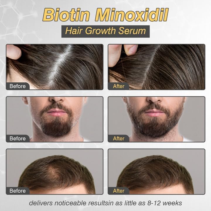 5% Minoxidil Hair Growth Serum for Men & Women