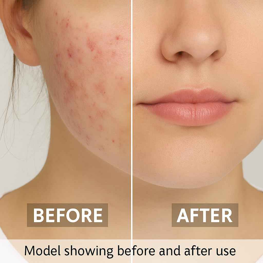 Benzoyl Peroxide 10% acne wash- Maximum Strength,Face back & Body Wash Skincare & acne treatment, it is a Foam wash 250ml. Dermatologist Recomended Maximum Strength for Healthy and acne free Skin.