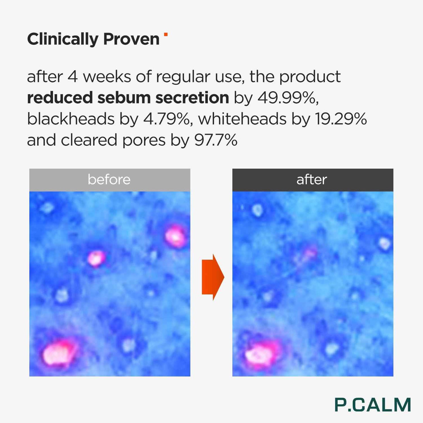 P.CALM Underpore Foam Cleanser – Azulene for Deep Pore Cleansing, Blackhead & Whitehead Removal, Korean Vegan Facial Wash for Sensitive Skin (250ml / 8.45 fl.oz)