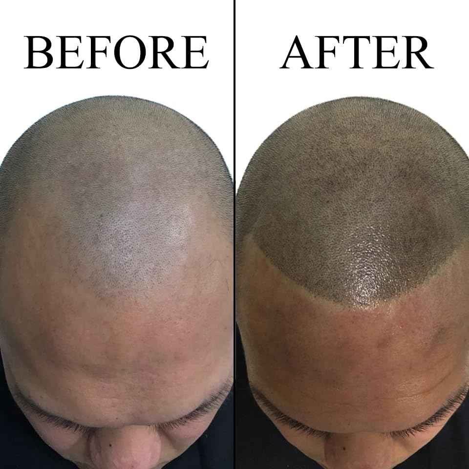 Nuva Follifill SMP Pigment & Cartridge Needle Kit – Deepest Scalp Micropigmentation Ink with Superior Retention, 15ml Bottle for 50+ Treatments, 20 Sterilized Needles, Mixer, Hue Balance