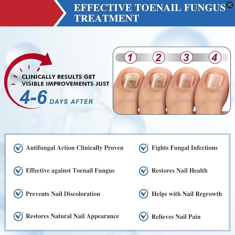 Terquenix Toenail Fungus Treatment Pen – Extra Strength