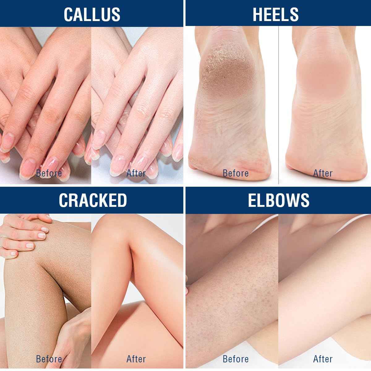 OUKEYA Urea Cream 40 Percent, Foot & Hand Cream for Dry Cracked, Urea Lotion for Feet Maximum Strength(12.35Oz X 2 Packs)