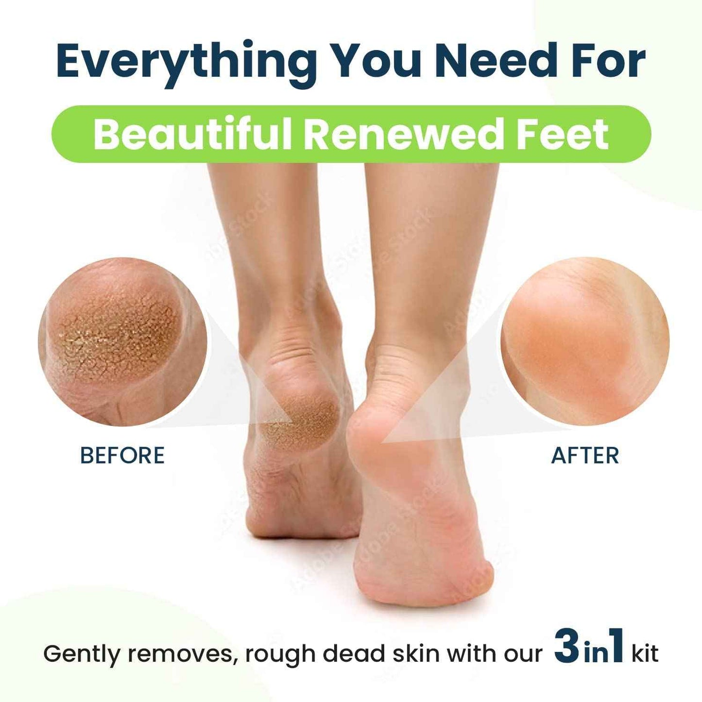 Tea Tree Oil Foot Soak with Epsom Salt Callus Remover for Feet with Extra Strength Gel & Foot Pumice Stone Set - Easy Way to Remove Hard Calluses & Dead Skin Build-Up - Professional at-Home Foot Care