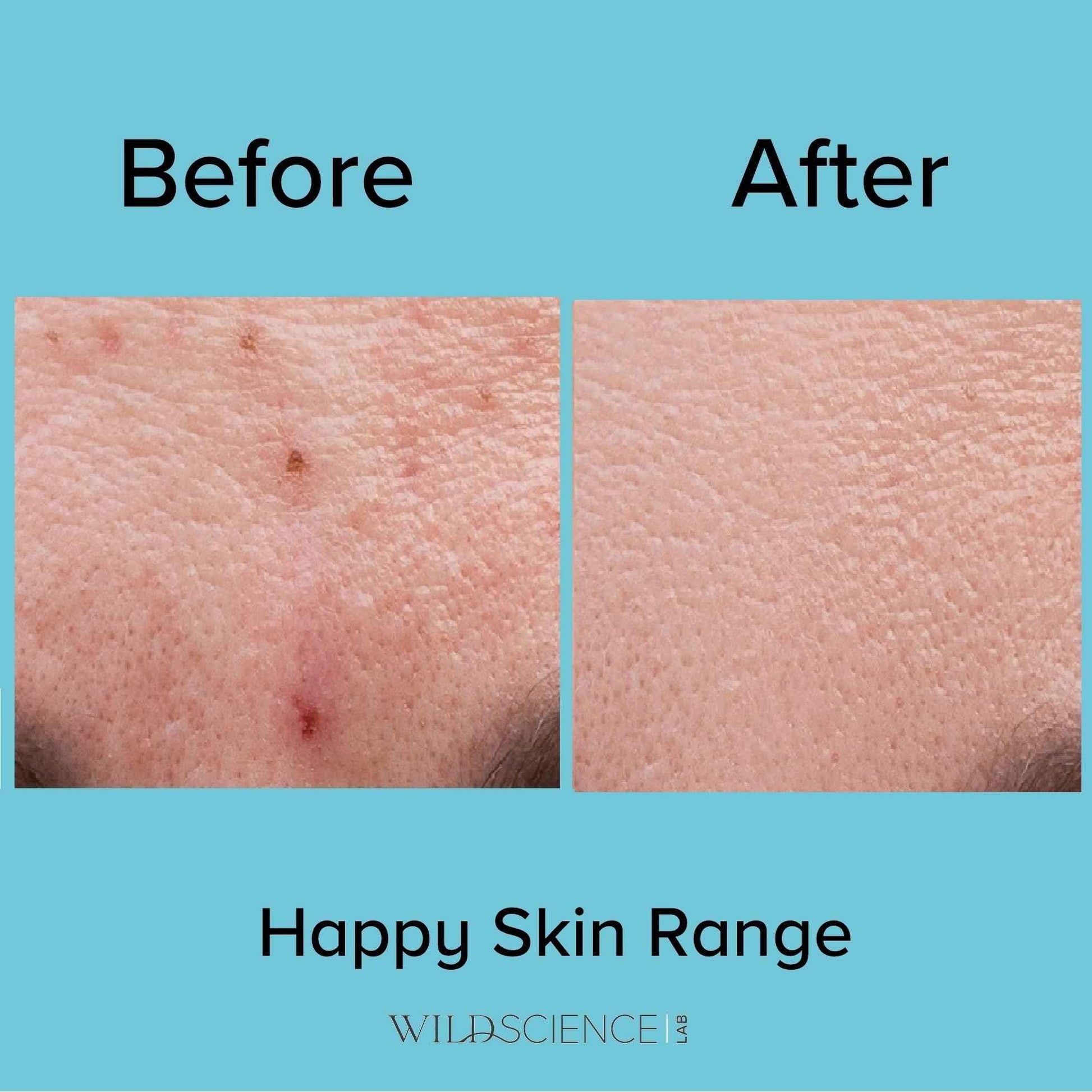 Wild Scicen Lab HAPPY BALANCE AHA + BHA + Zinc Clarifying Essence for Acne-Prone Skin