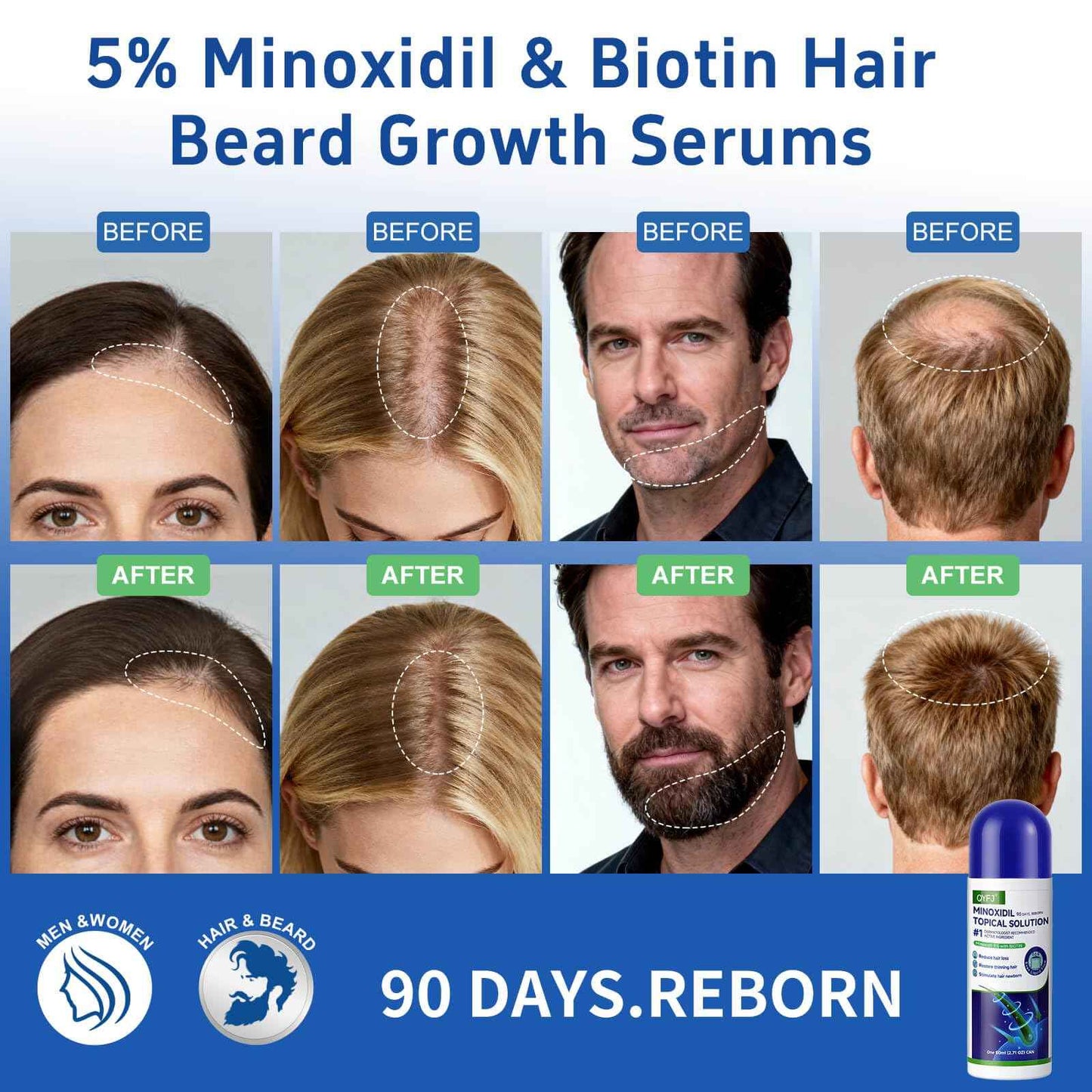 QYFJ blue 5% minoxidil hair growth Serum for women & men with biotin - with sponge applicator for thinning hair & receding hairline 8-month supply-6pcs Packs 2.71 fl oz per bottle