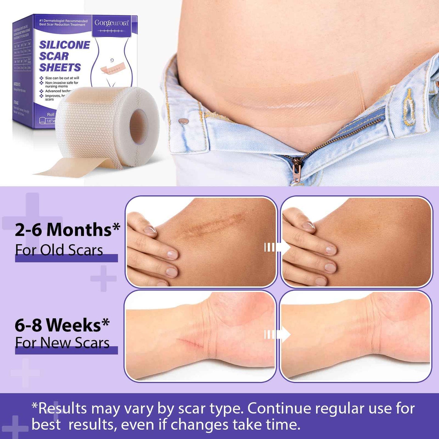 Silicone Scar Sheets, Silicone Scar Tape (1.6” x 60” Roll, 1.5M) – Reusable Silicone Scar Sheets for Surgical Scars, C-Section, Keloids, Burns, Acne, and Keloid Bump Removal