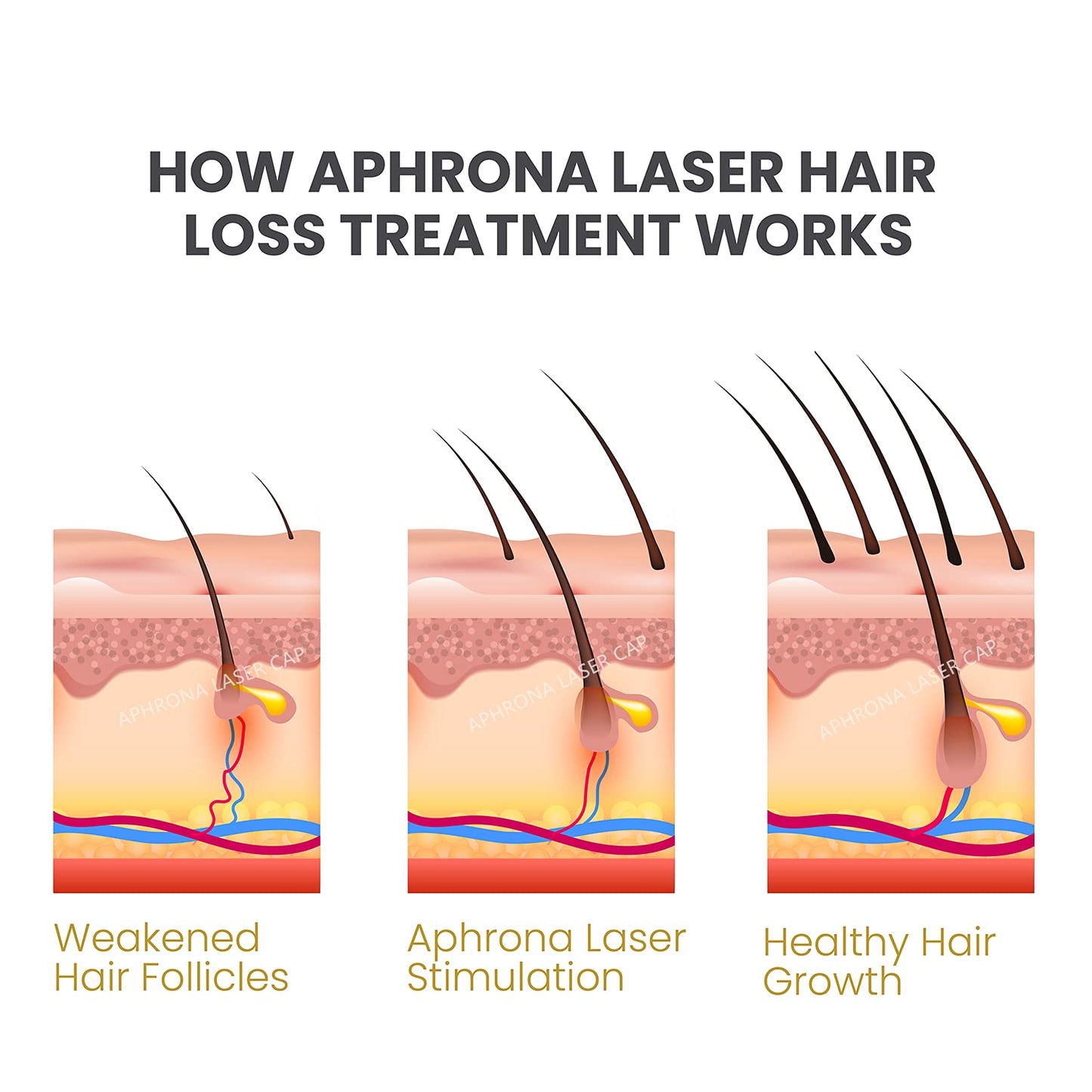 Aphrona® Advanced Hair Growth System 272 HairPro for Men and Women I For Mild to Moderate Hair Loss I Rechargeable Laser Cap for Hair Regrowth I Clinically Proven I FDA Cleared for Men and Women