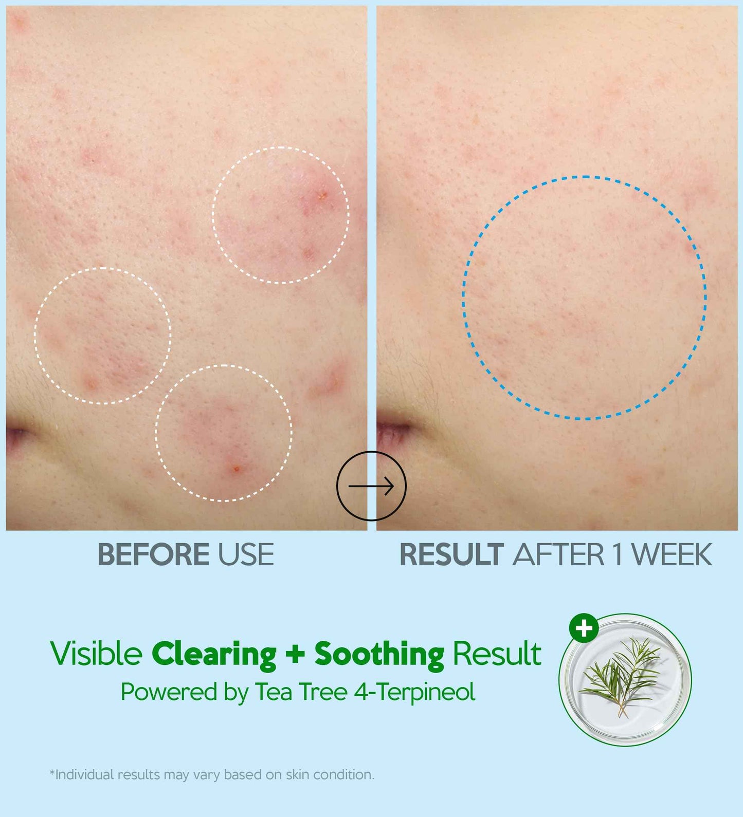 Troubless Hydro Soothing Moisture Cream - Deep Hydration & Skin Barrier Cream for Face w/ 10,000 ppm Panthenol & Tea Tree 4-Terpineol - Soothing & Non-Greasy Face Moisturizer (2.36 fl oz)